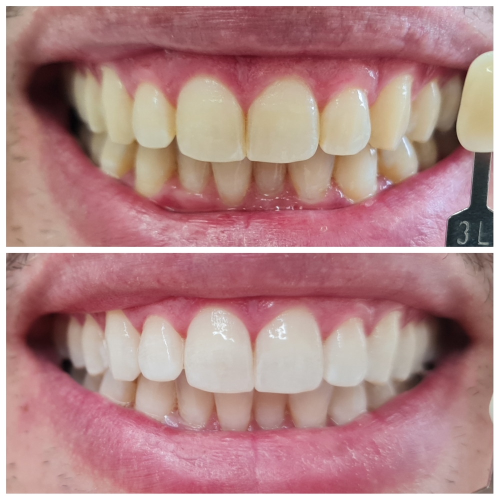 Resultado de clareamento dental - antes e depois