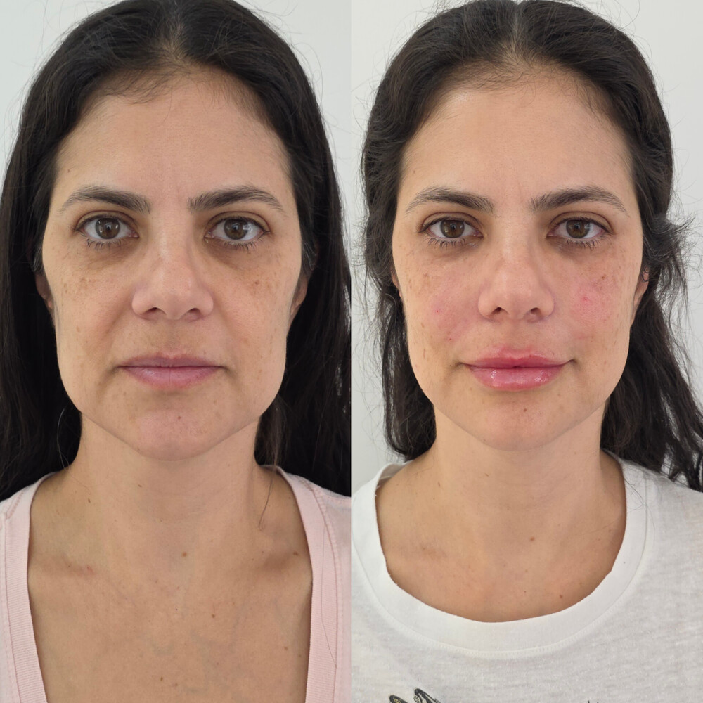 Resultado de Full Face - antes e depois
