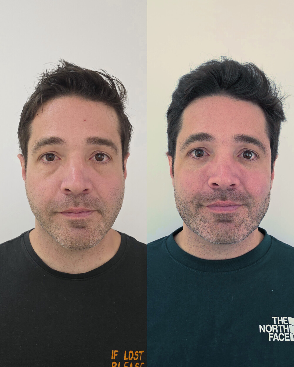 Resultado de Full Face - antes e depois