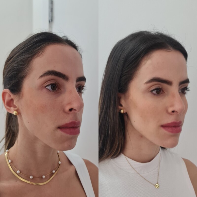 Resultado de Full Face - antes e depois