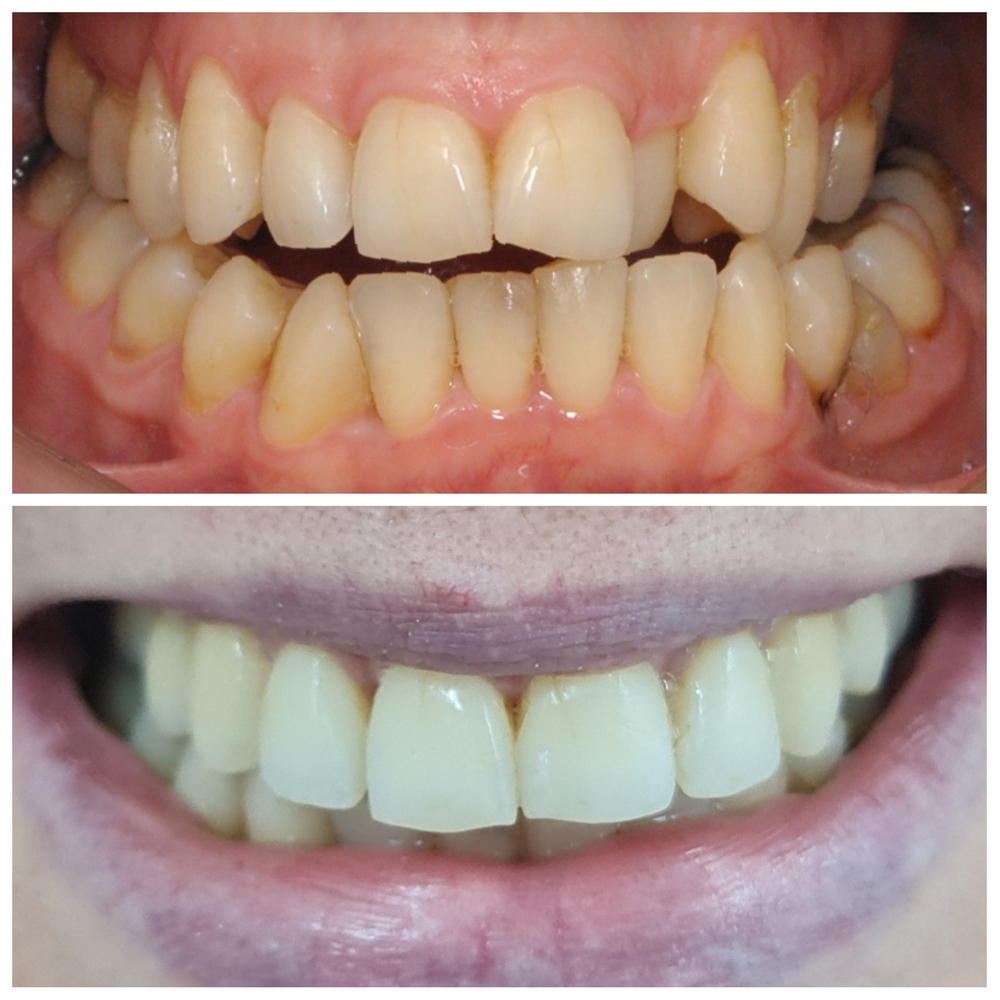 Resultado de ortodontia - antes e depois